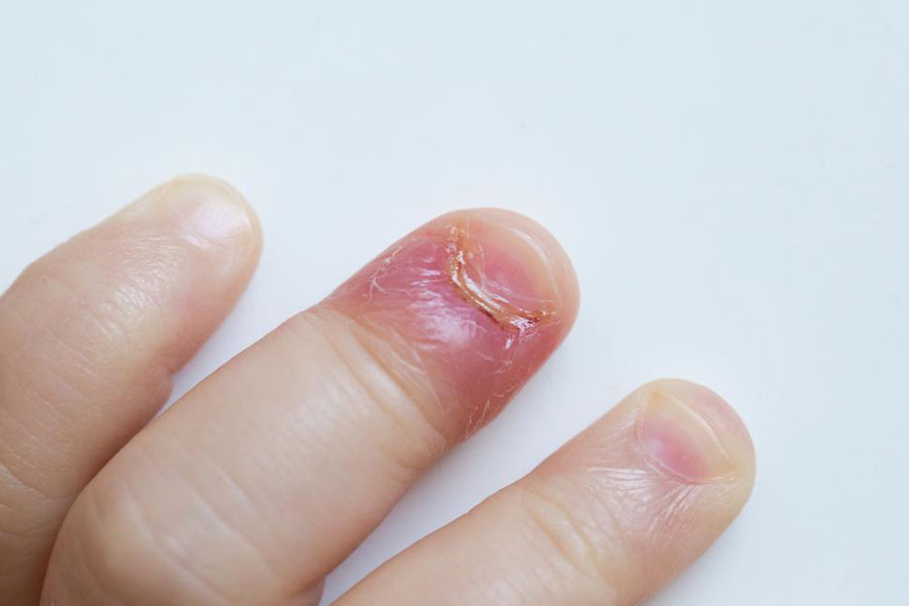 Causes and Symptoms of Swollen Finger Discomfort