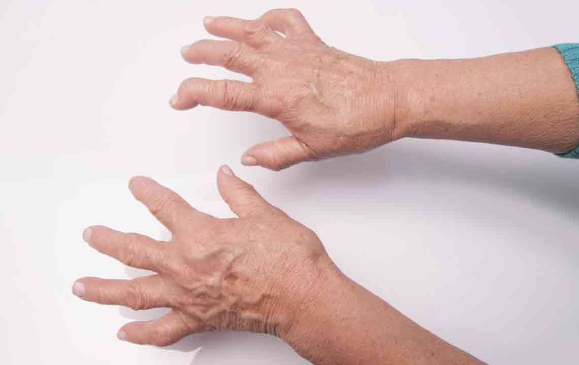 Essential Dietary Tips for Managing Arthritis Symptoms