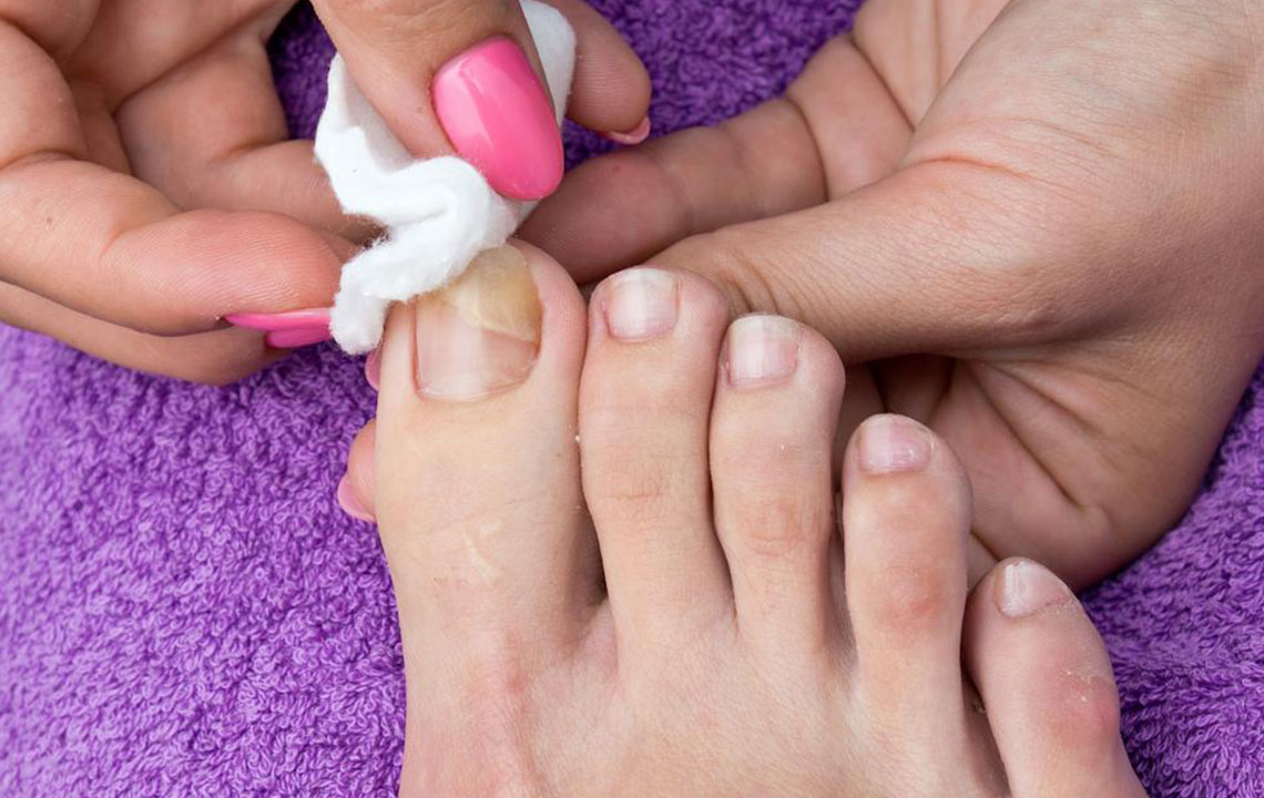 Effective Strategies to Treat and Prevent Nail Fungal Infections