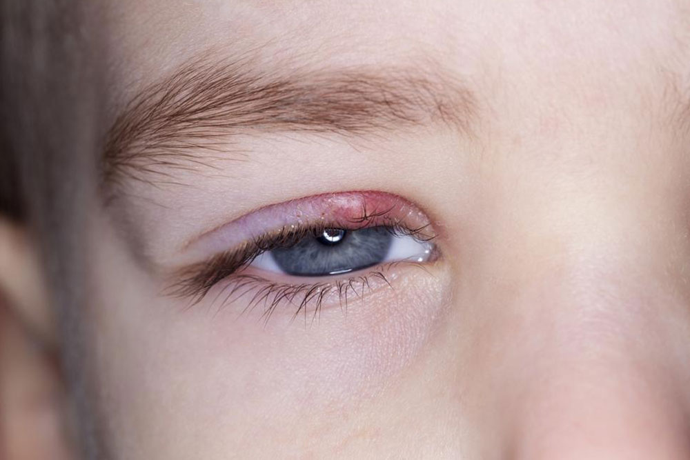 Top Causes of Blepharitis and How to Recognize Them