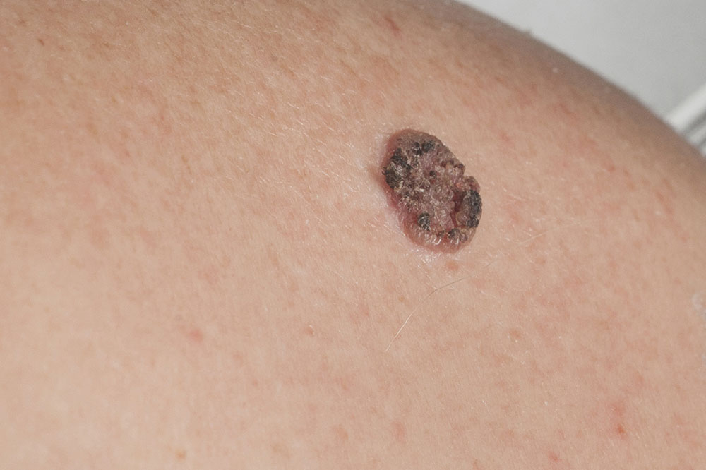 Understanding Carcinoma: Types, Symptoms, and Key Facts