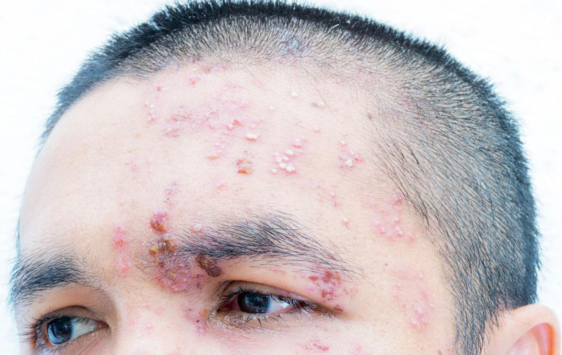 Understanding and Managing Nerve Pain Caused by Shingles