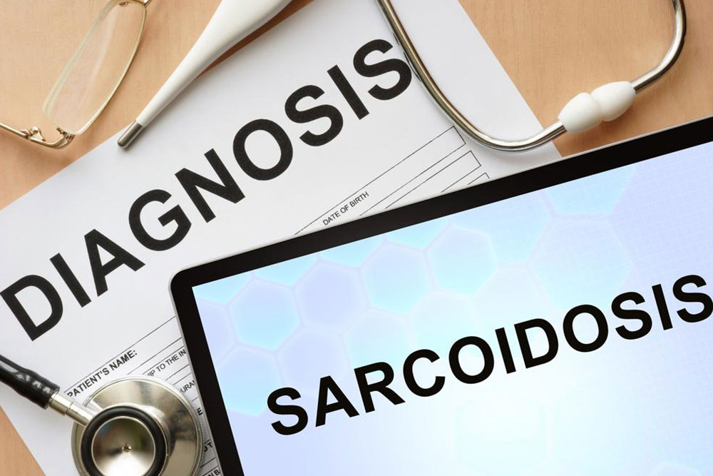 Comprehensive Guide to Identifying the Early Signs and Symptoms of Sarcoidosis