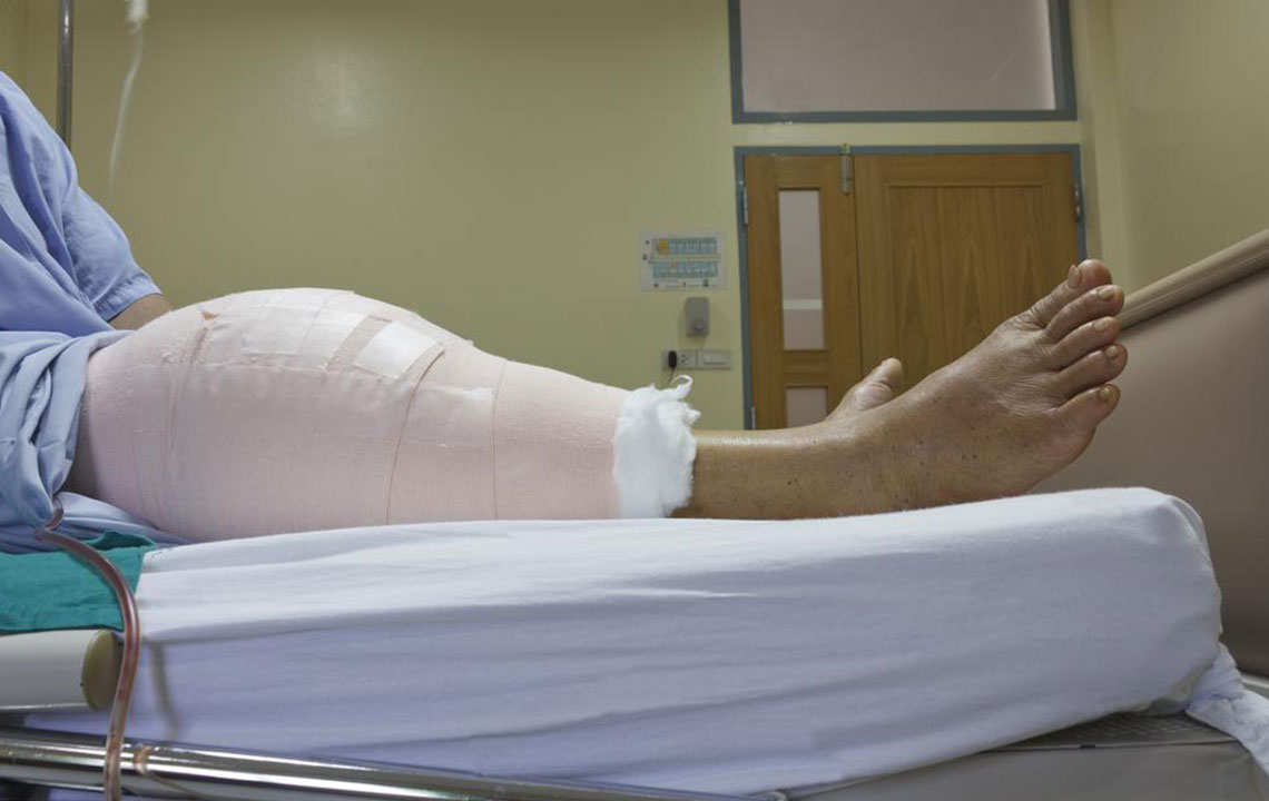 Essential Insights Into Knee Arthroplasty Procedure