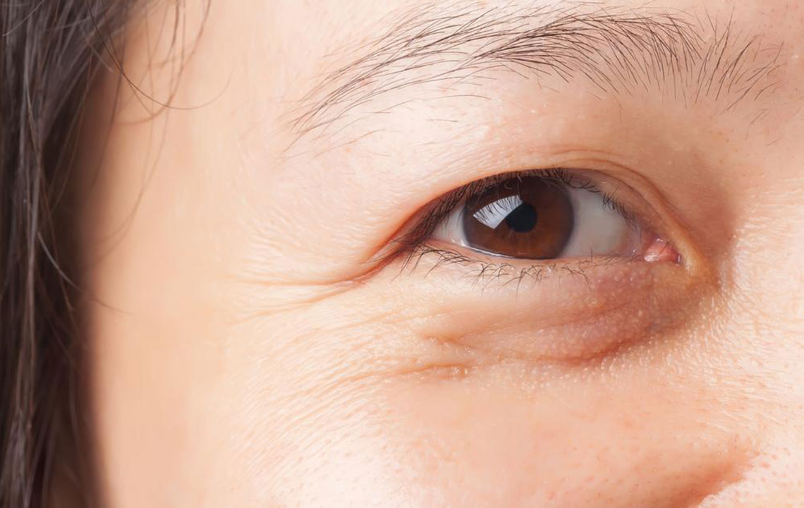 Effective Home Hacks to Reduce Under-Eye Puffiness
