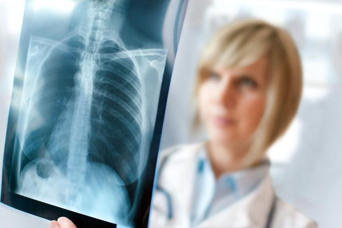 Essential Signs of Lung Cancer You Shouldn't Overlook