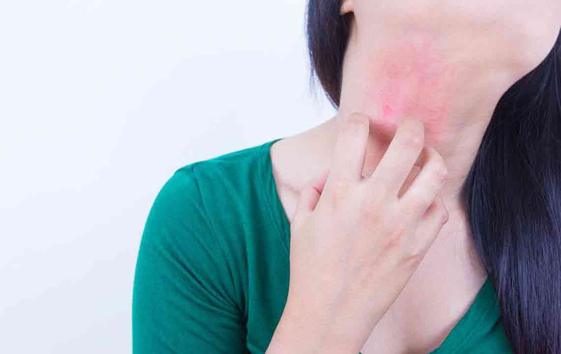 Effective Over-the-Counter Remedies for Eczema Relief