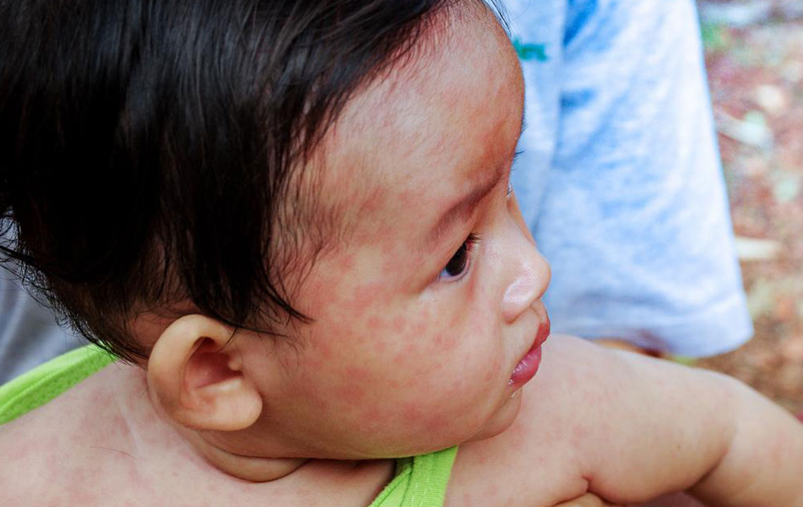 Recognizing the 10 Early Indicators of Lupus