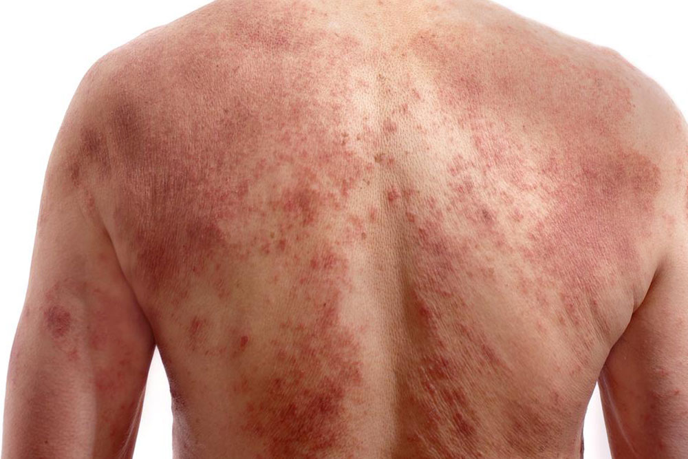 Quick Indicators of Chickenpox Infection