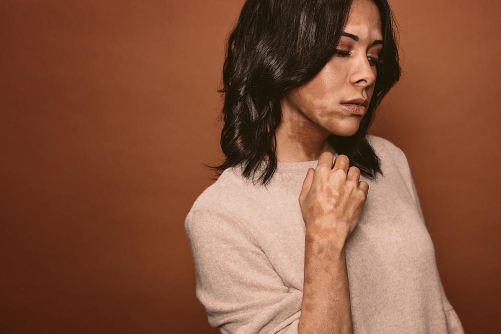 Natural Strategies to Support Vitiligo Management