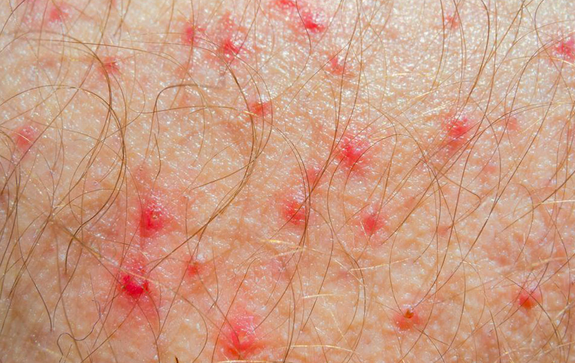 Comprehensive Guide to Atopic Dermatitis and Its Variants