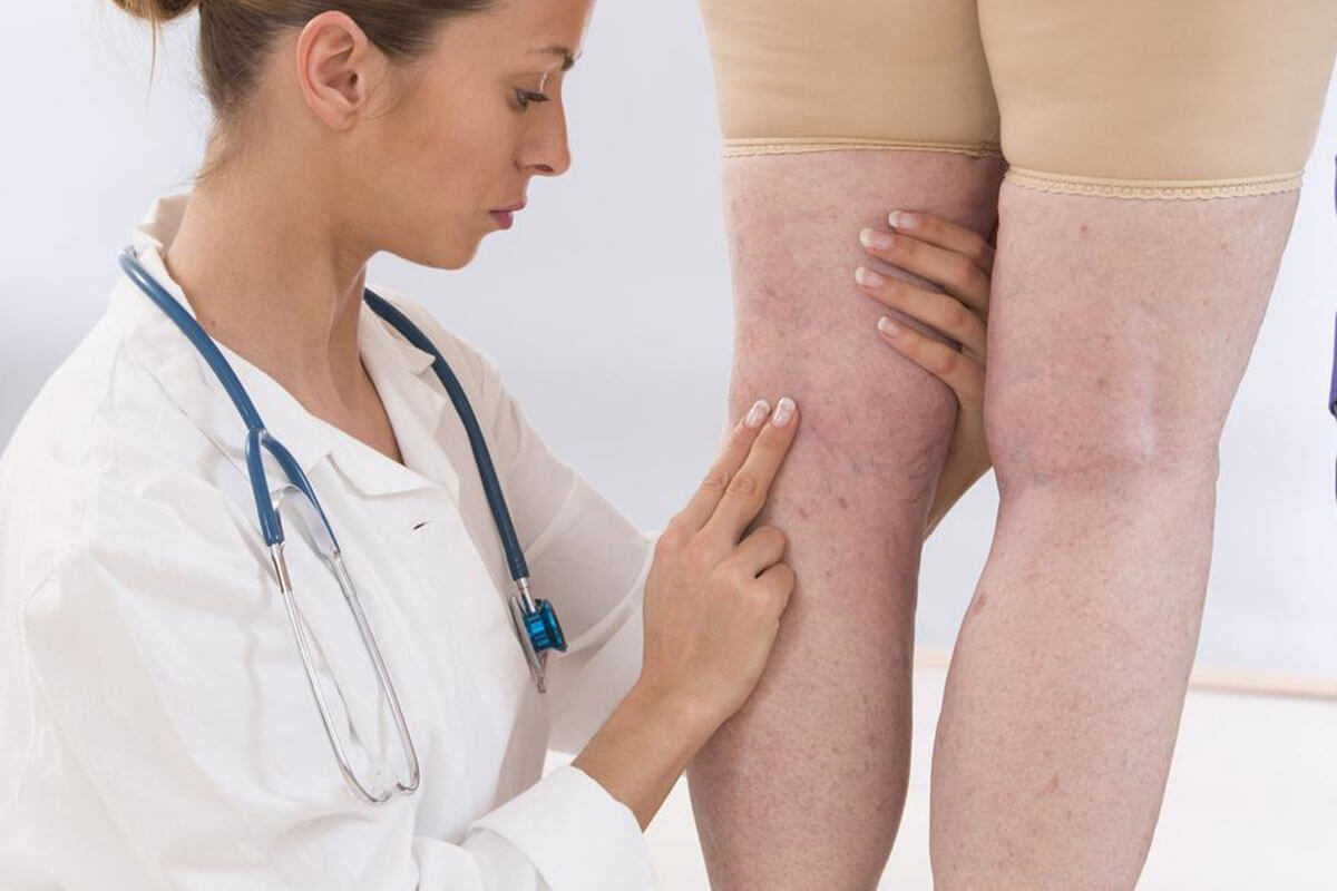Effective Approaches for Managing Deep Vein Thrombosis
