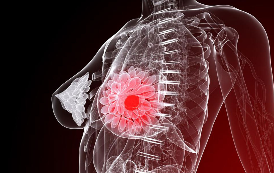 Essential Facts About Breast Cancer You Should Know
