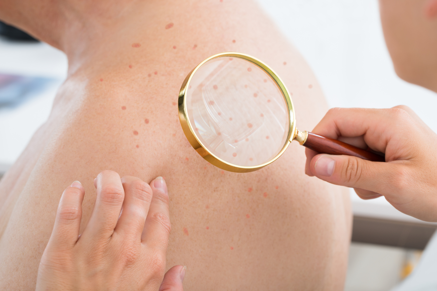 Understanding Cellulitis: Causes, Symptoms, and Prevention