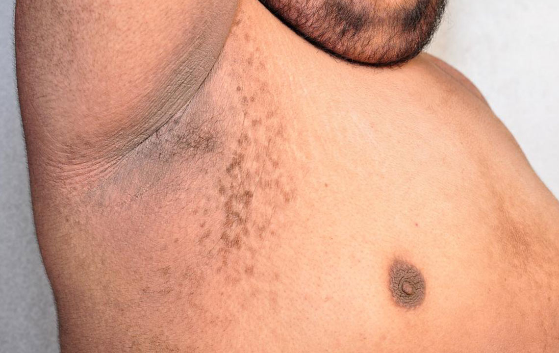 Effective Natural Solutions for Underarm Rash Relief
