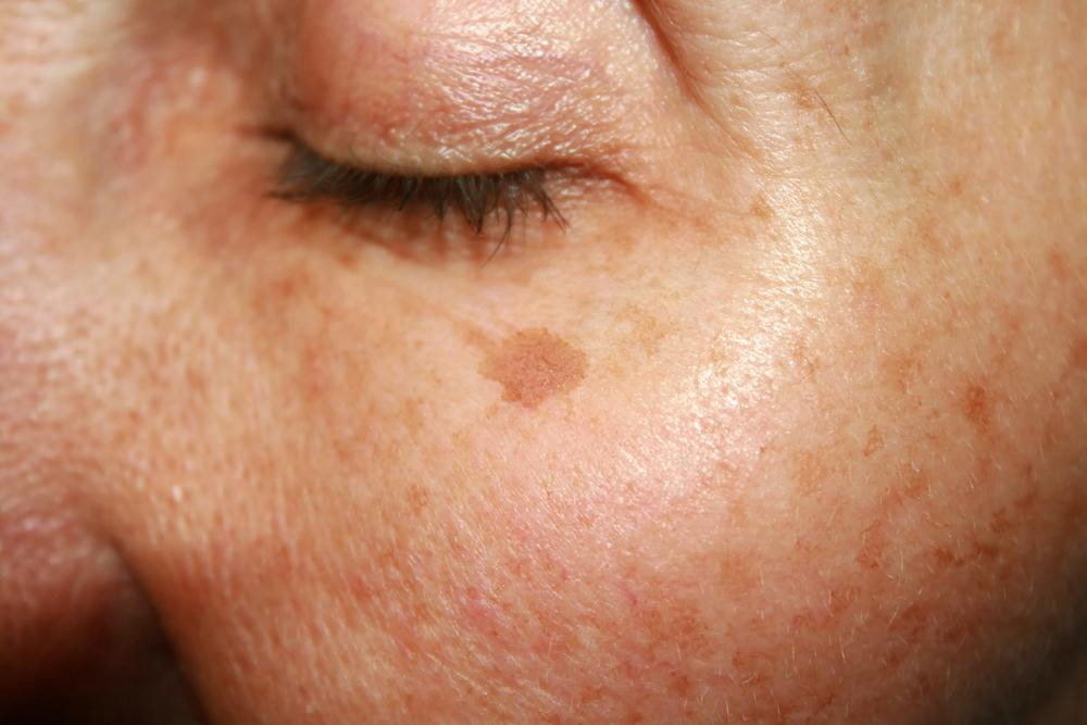Affordable Natural Solutions for Reducing Age Spots Effectively