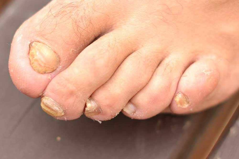Effective Strategies for Healing Nail Fungus Naturally