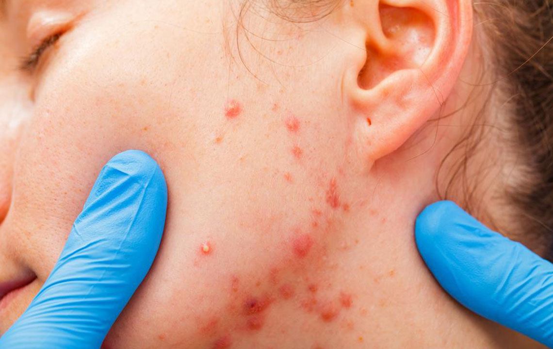 Ultimate Guide to Managing and Treating Rosacea for Healthy Skin