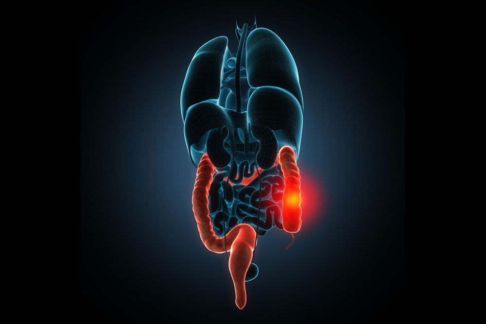 Effective Strategies for Managing Irritable Bowel Syndrome