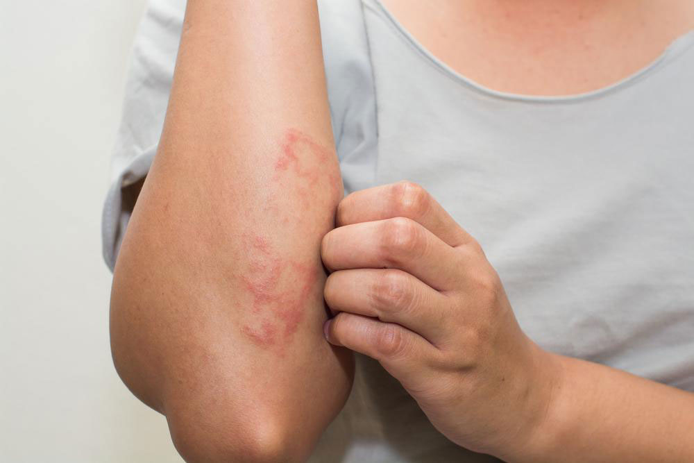 Comprehensive Guide to Mycosis Fungoides: Diagnosis and Treatment Options