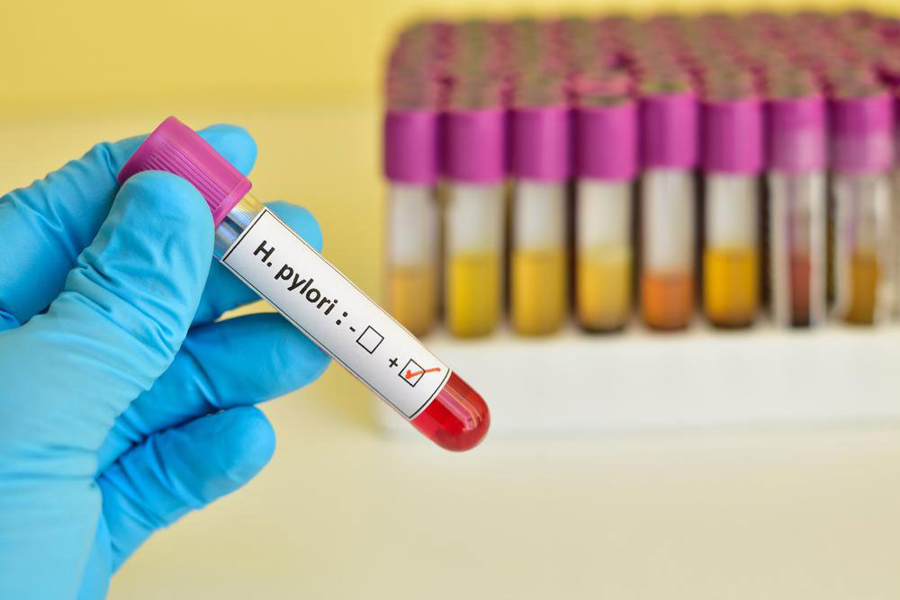 Essential Insights into Helicobacter Pylori Infection