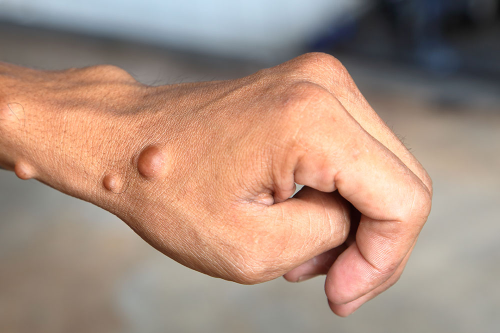 Comprehensive Guide to Neurofibromatosis: Symptoms, Causes, and Management