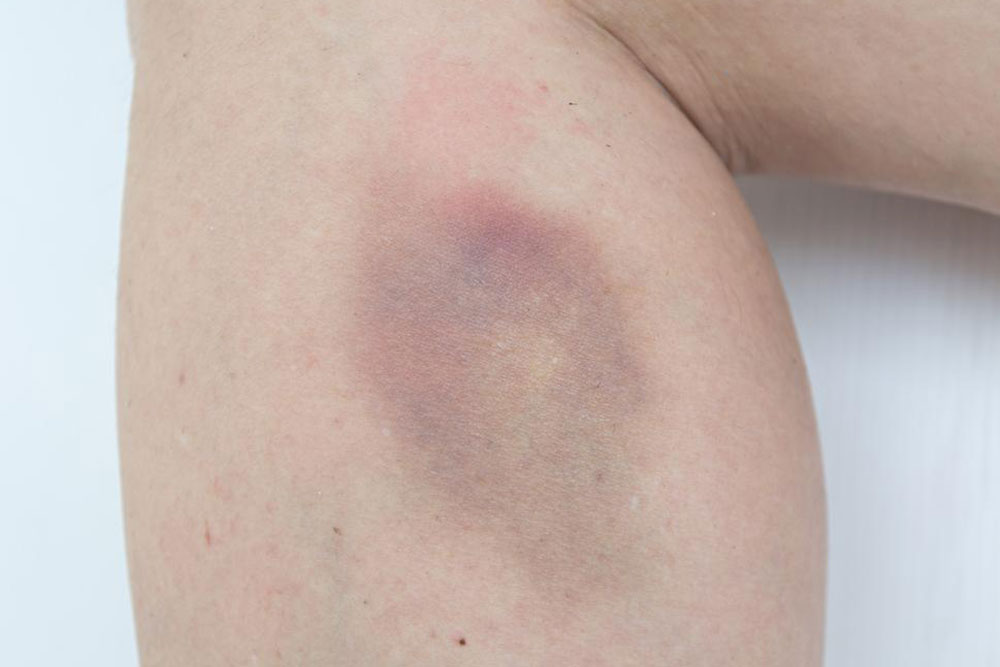 Understanding Easy Bruising: Causes and Remedies