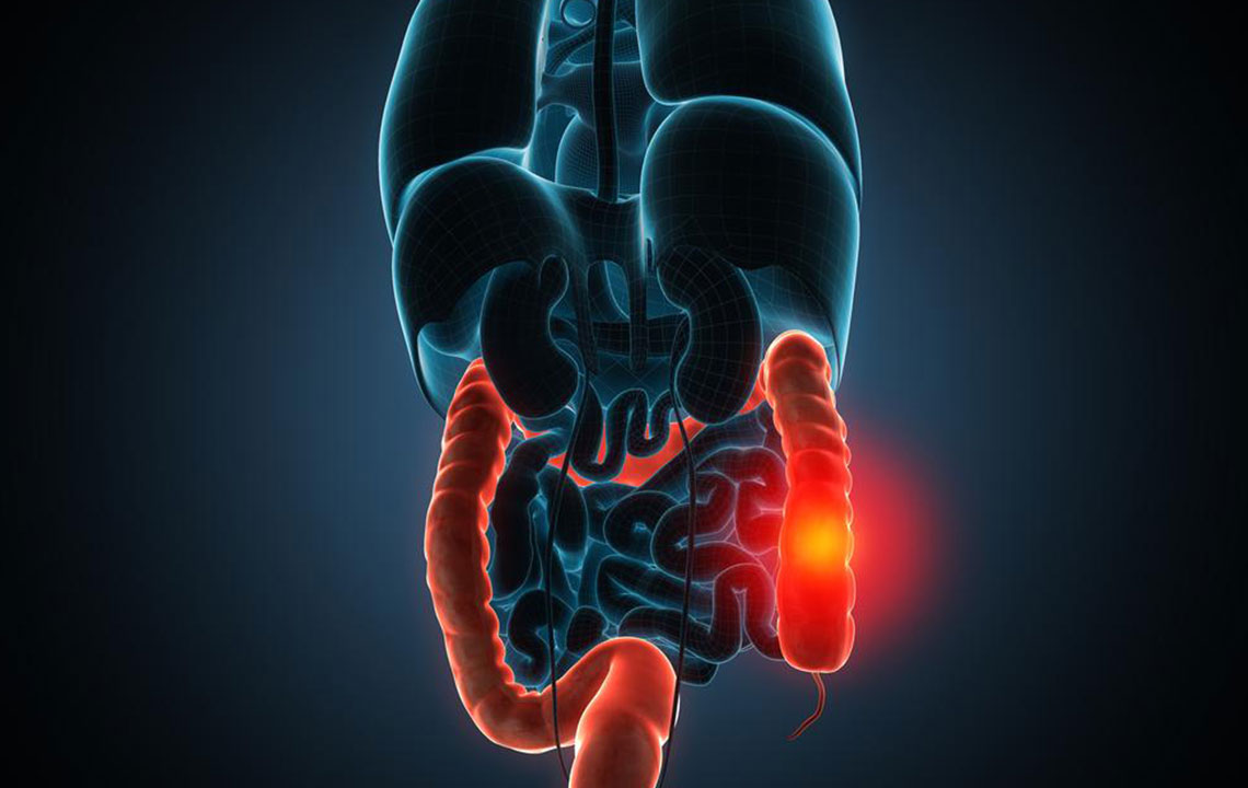 Identifying Signs and Symptoms of Diverticulitis