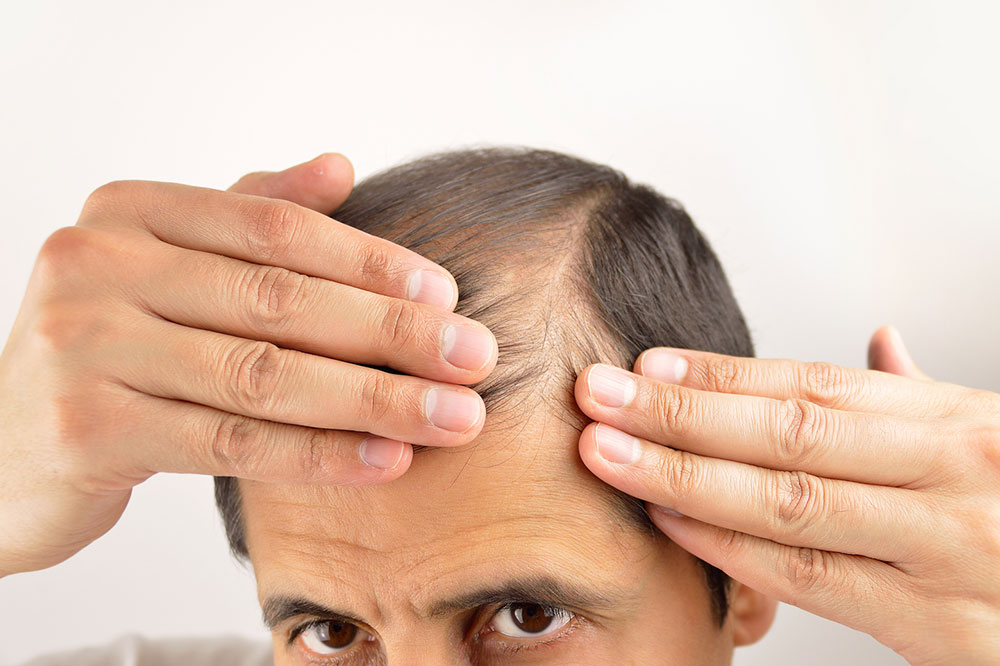 Effective Strategies for Combating Hair Loss