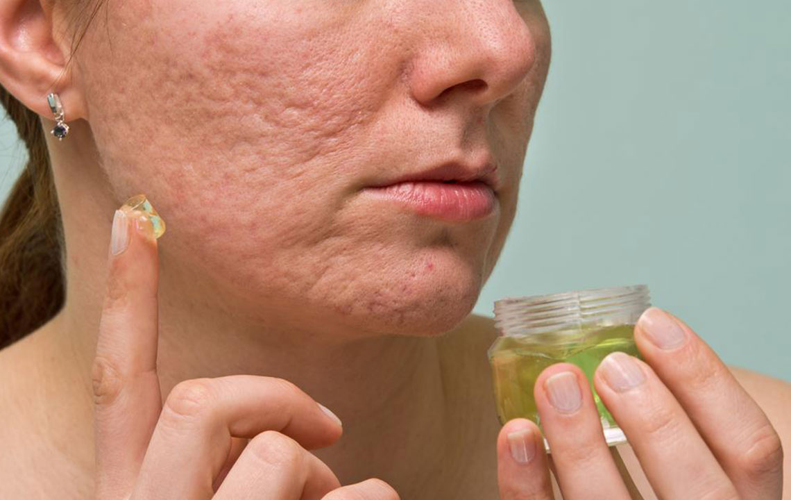 Effective Strategies for Reducing Acne Scars, Marks, and Blemishes