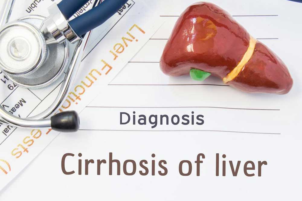 Understanding Liver Cirrhosis: Stages and Management