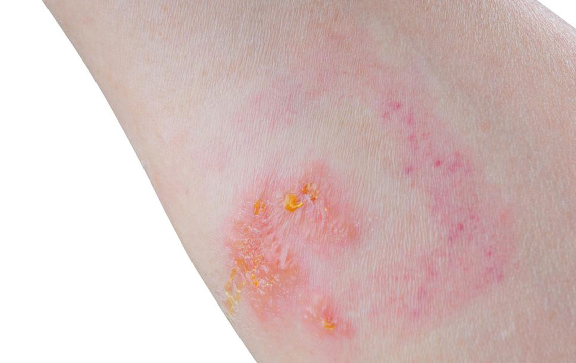 Comprehensive Guide to Skin Eruptions: Causes, Types, and Effective Treatments