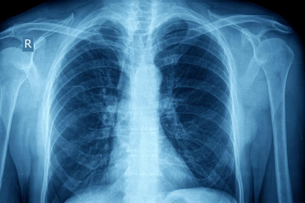 Understanding Asthma: Causes, Mechanisms, and Effects