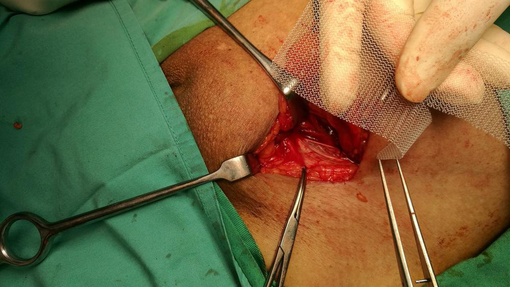 Understanding Umbilical and Femoral Hernias: Symptoms and Risks