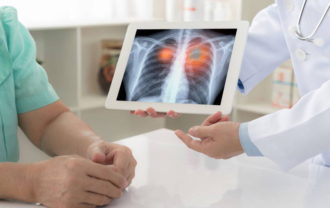 Understanding the Stages of Lung Cancer