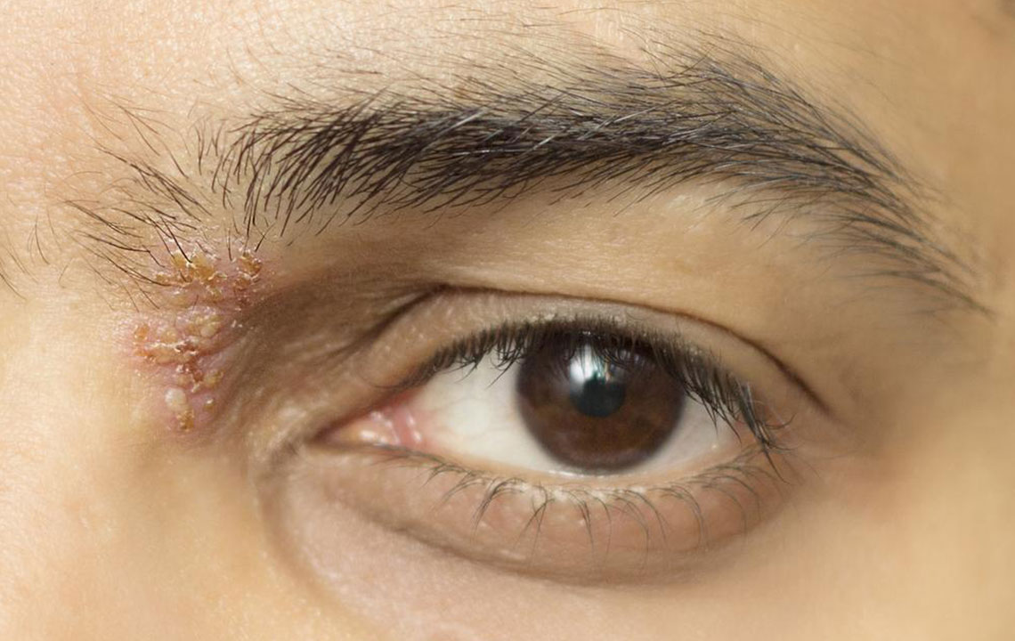 Understanding the Root Causes of Shingles