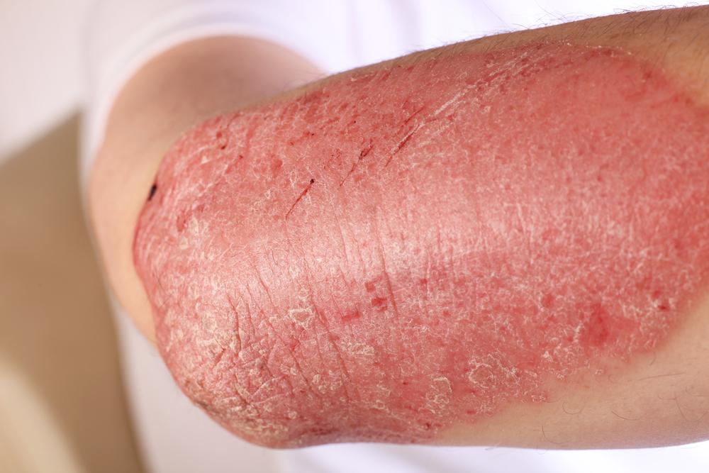 Understanding Eczema: Symptoms, Causes, Types, and Treatments
