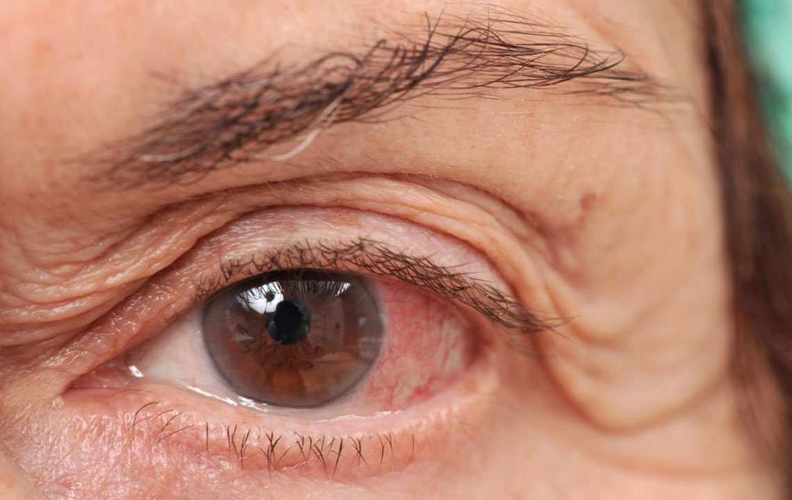 Effective Strategies for Managing Chronic Dry Eye Syndrome