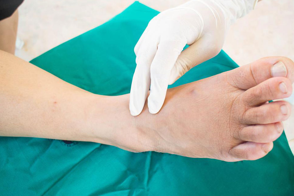 Early Intervention Strategies for Managing Gangrene