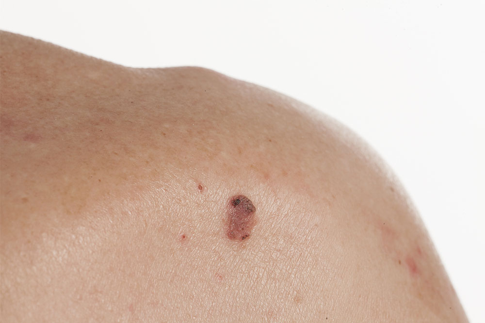 Comprehensive Guide to Common Carcinomas: Types, Symptoms, and Treatment Strategies