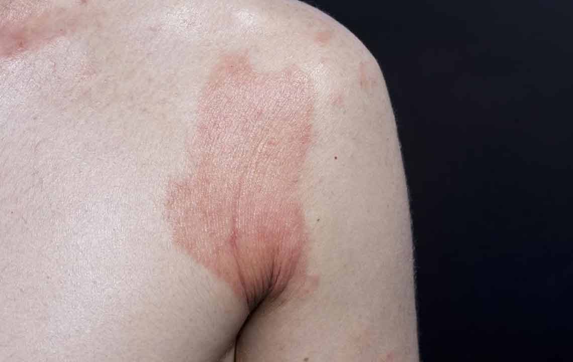 Essential Guide to Recognizing and Understanding Skin Rashes