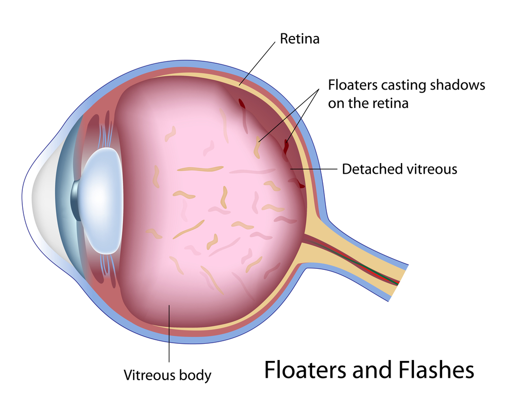 A Comprehensive Guide to Eye Floaters: Causes, Symptoms, and Effective Management