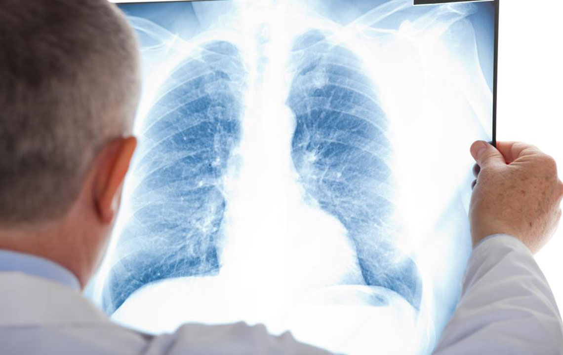 Essential Insights into Mesothelioma: Causes, Symptoms, and Treatment Options