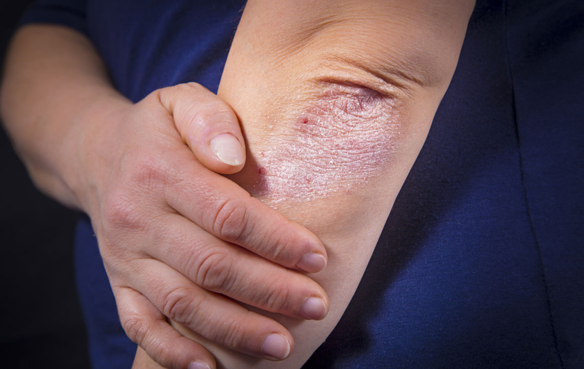 Understanding Psoriasis: Symptoms and Contributing Factors