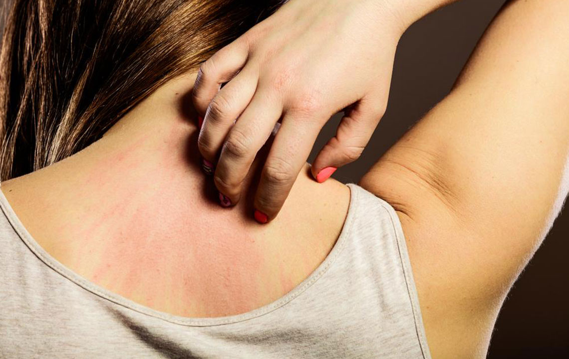Comprehensive Guide to Managing and Understanding Scabies Infestation