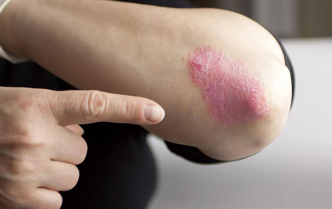 Effective Strategies for Managing Chronic Plaque Psoriasis