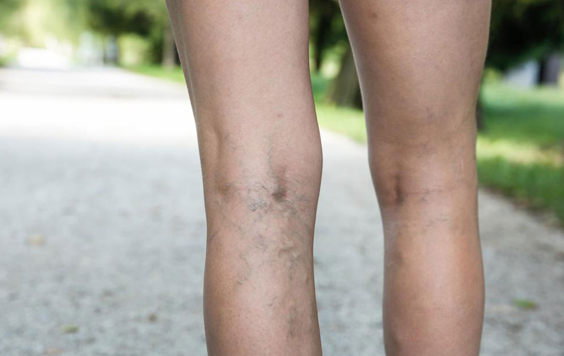 Essential Insights on Deep Vein Thrombosis and Prevention