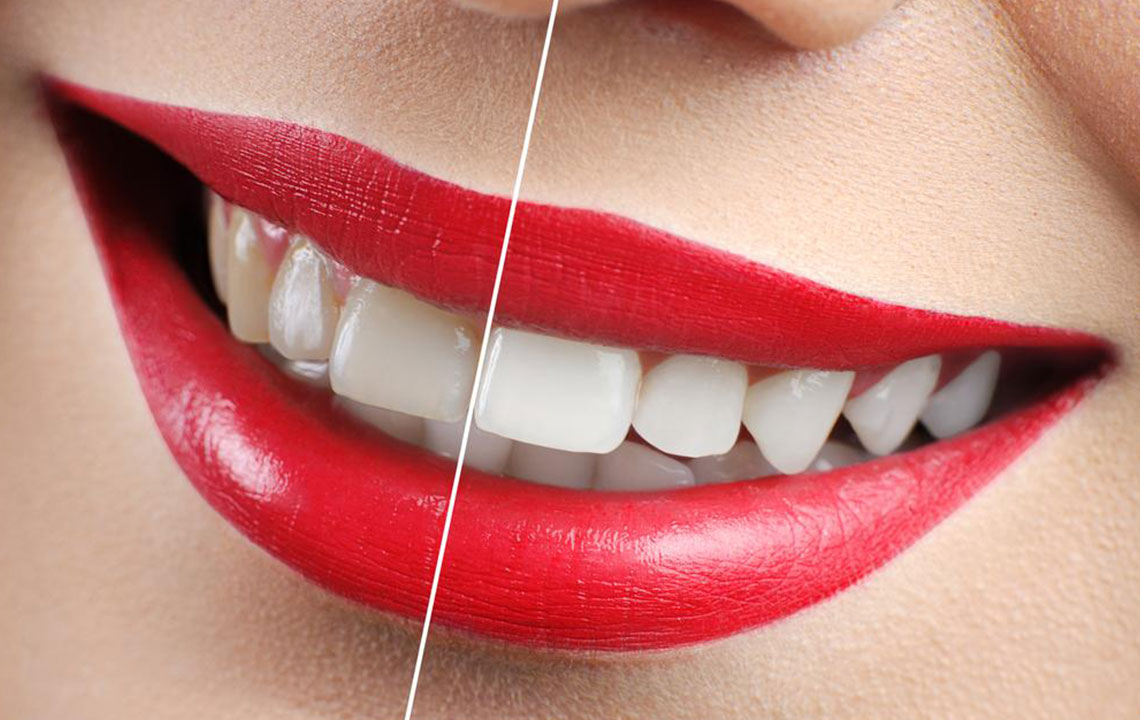 Tips to Prevent and Treat Yellowing Teeth