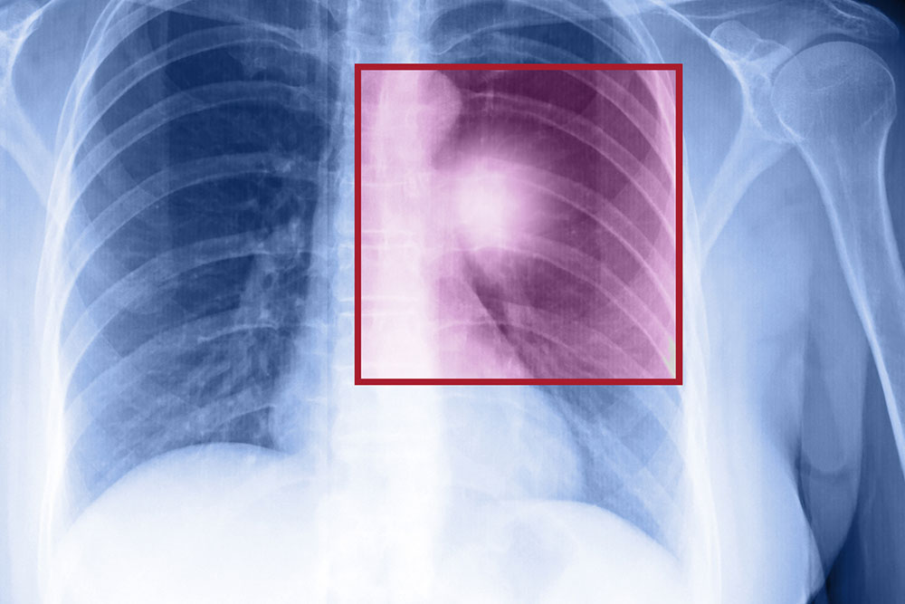 Understanding and Managing Advanced Lung Cancer Spread