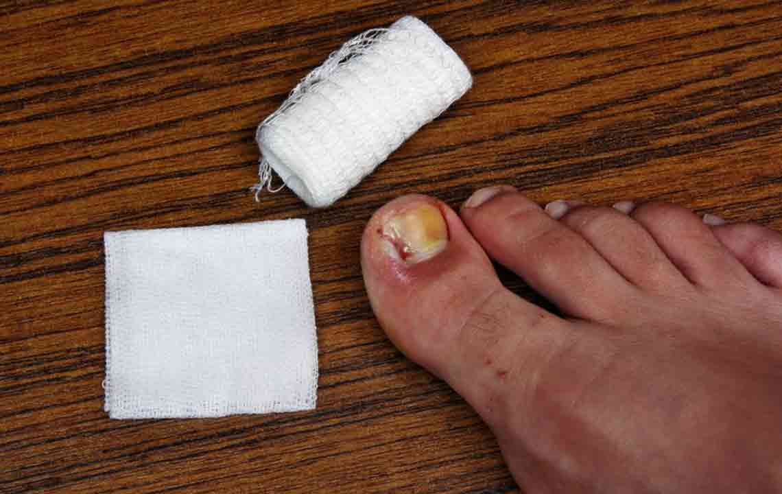 Effective Strategies for Fungal Nail Care